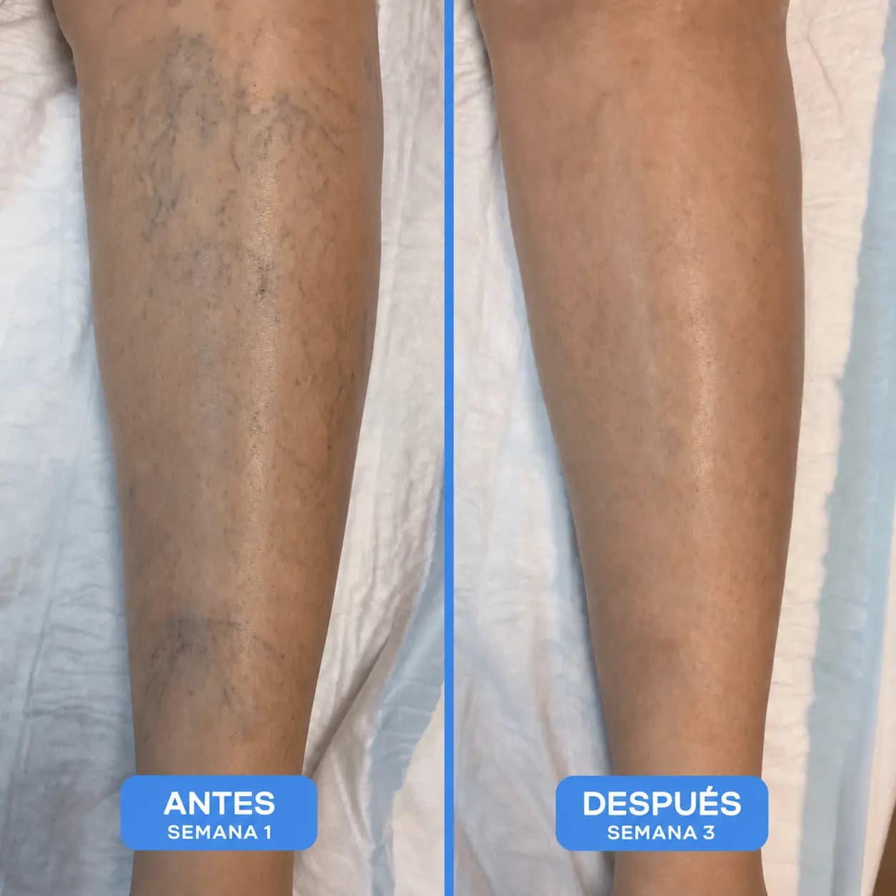 Crema Varicose Alifeet® | Alivio para Piernas Pesadas, Arañitas y Várices.
