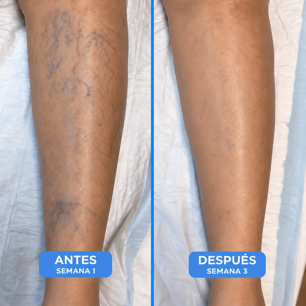 Crema para Piernas Varicosyl Alifeet ®